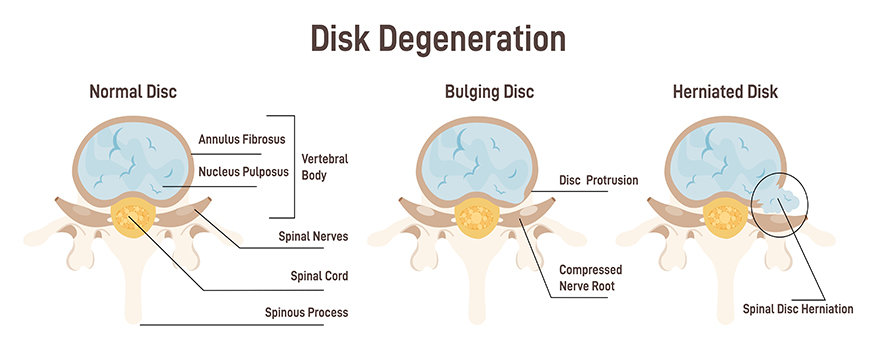 Disc Injuries